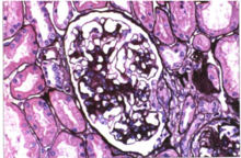 中度系膜增生 中度系膜增生