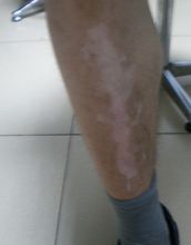 皮肤白班 皮肤白班