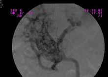 反流性食管炎影像 反流性食管炎影像