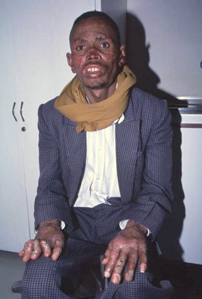 cutaneous leishmaniasis